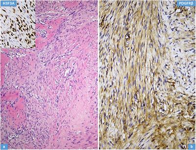 The Activation of PDGFRβ on Mononuclear Stromal/Tumor Cells in Giant Cell Tumor of Bone After Denosumab Treatment. An Immunohistochemical Study of Five Cases